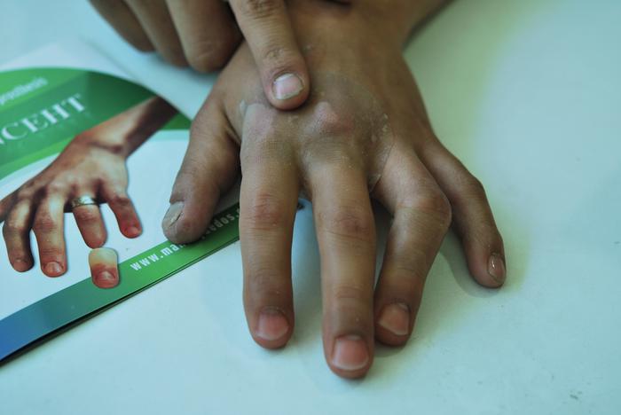 protesis para dedo